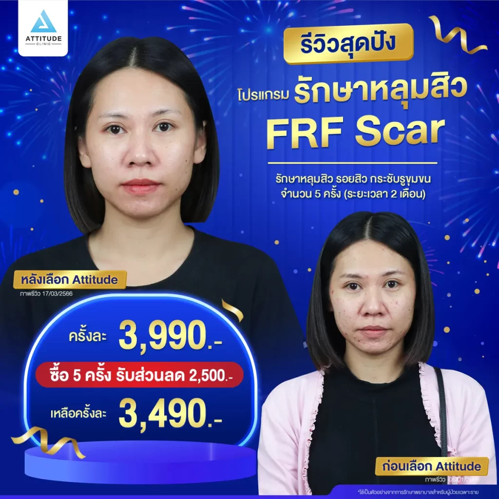 รวมรีวิวรักษาหลุมสิวสุดปัง บอกลาหลุมสิว ผิวดวงจันทร์ที่คอยกวนใจ