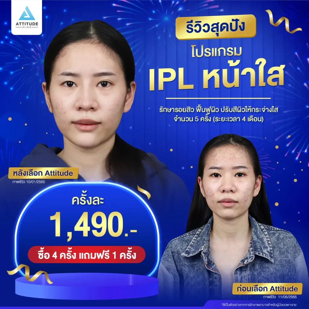 รวมรีวิวรักษารอยสิวสุดปัง อยากลบรอยสิว กู้ผิวพัง เลือกทำเลเซอร์เครื่องไหนดี !?