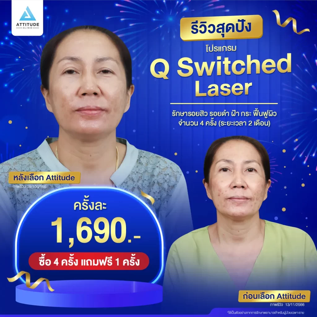 รวมรีวิวรักษารอยสิวสุดปัง อยากลบรอยสิว กู้ผิวพัง เลือกทำเลเซอร์เครื่องไหนดี !?