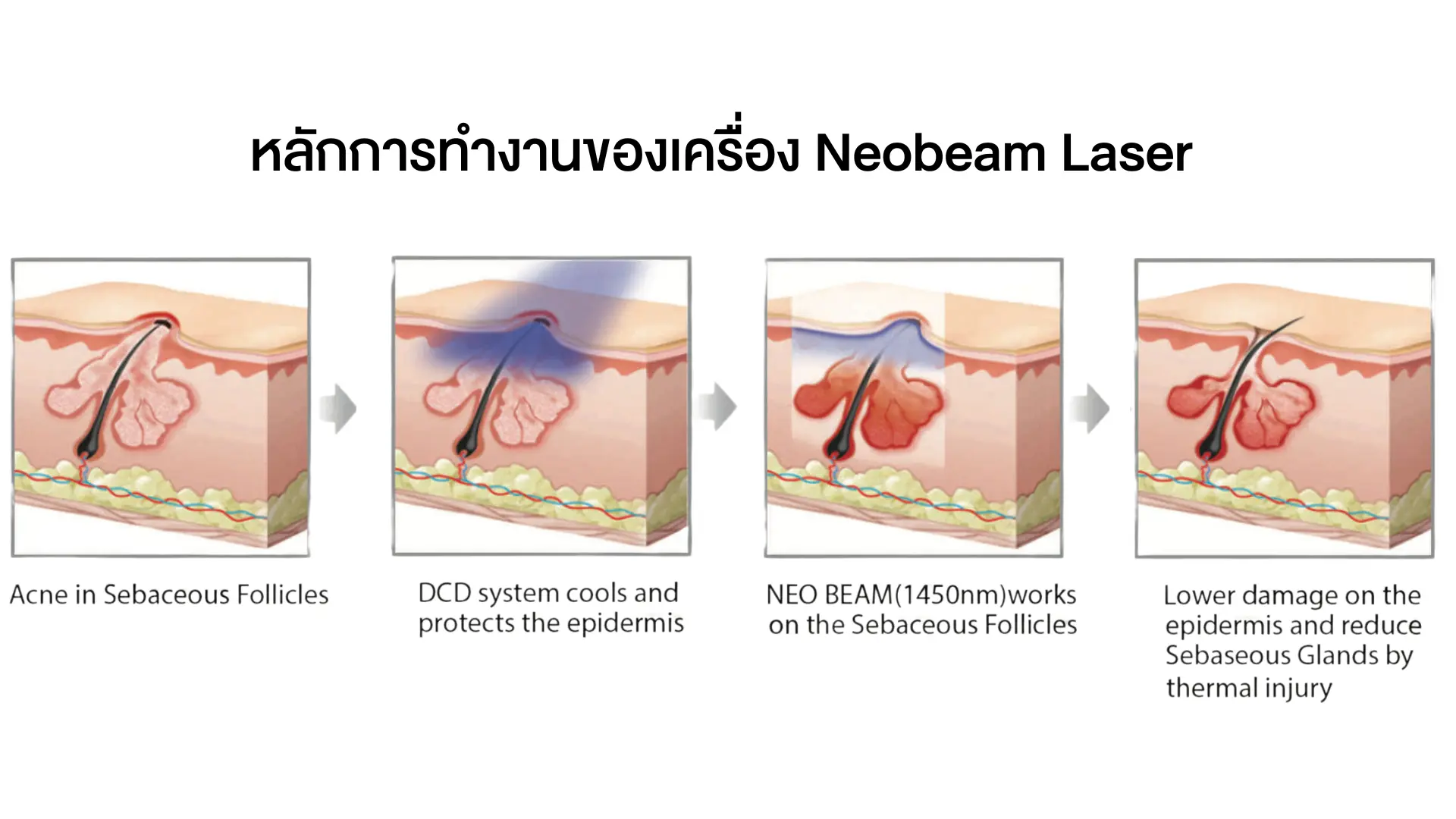 Neobeam Laser เลเซอร์รักษาสิว