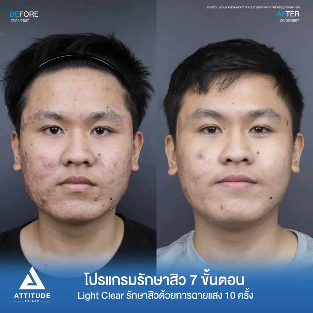 รีวิวรักษาสิวคุณอดิศร ด้วยการฉายแสง โปรแกรมรักษาสิว Light Clear 7 ขั้นตอน จำนวน 10 ครั้ง รักษาสิวอักเสบเม็ดใหญ่ สิวหนอง รอยแดงทั่วใบหน้าโดยเฉพาะข้างแก้มทั้ง 2 ด้านที่ Attitude Clinic