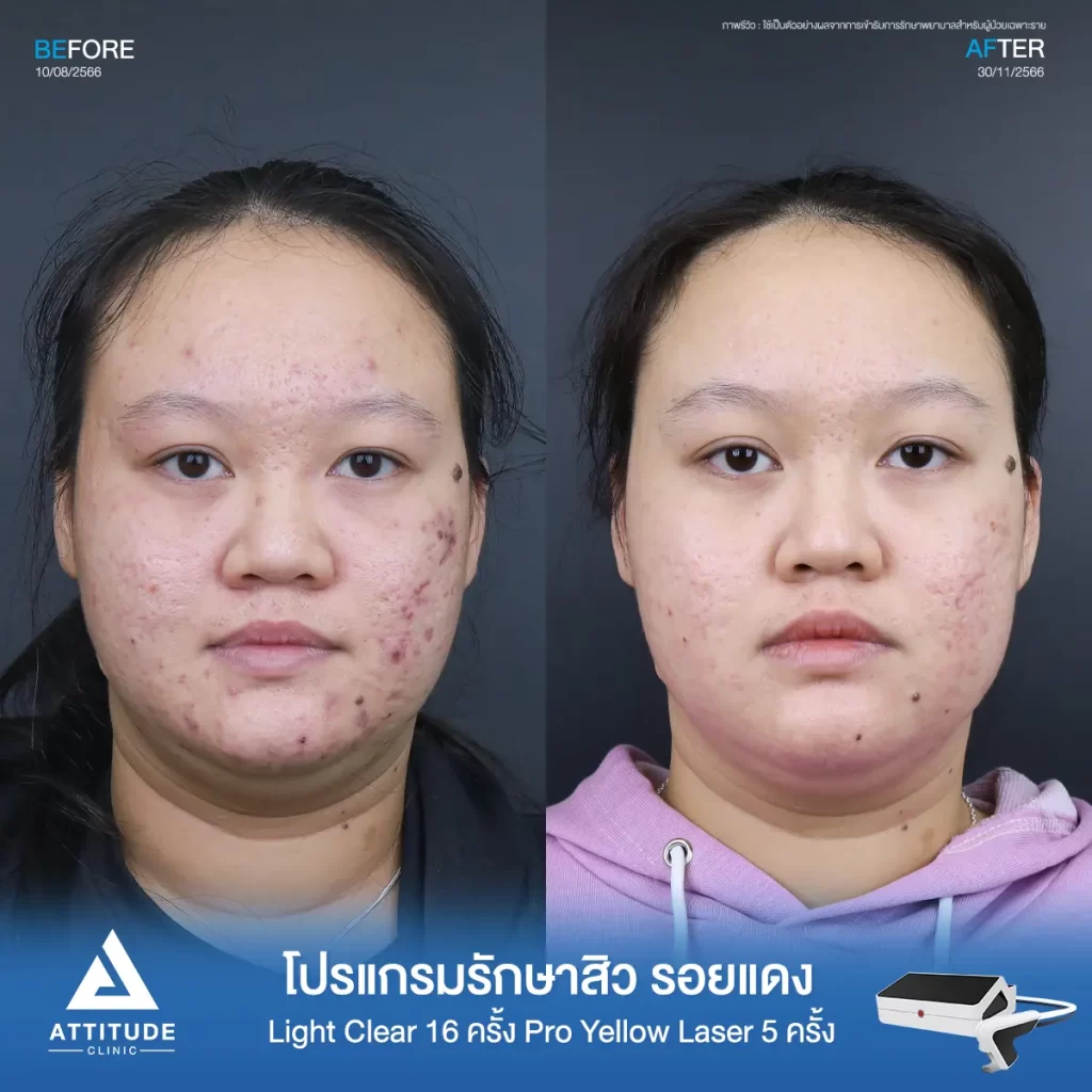 รีวิวรักษาสิวคุณกฤตชญา ด้วยการฉายแสงโปรแกรมรักษาสิว Light Clear 7 ขั้นตอน จำนวน 16 ครั้ง ต่อด้วย Pro Yellow Laser รักษารอยแดง จำนวน 5 ครั้ง รักษาสิวอักเสบ สิวอุดตัน รอยแดงจากสิวทั่วใบหน้าโดยเฉพาะบริเวณแก้มที่ Attitude Clinic