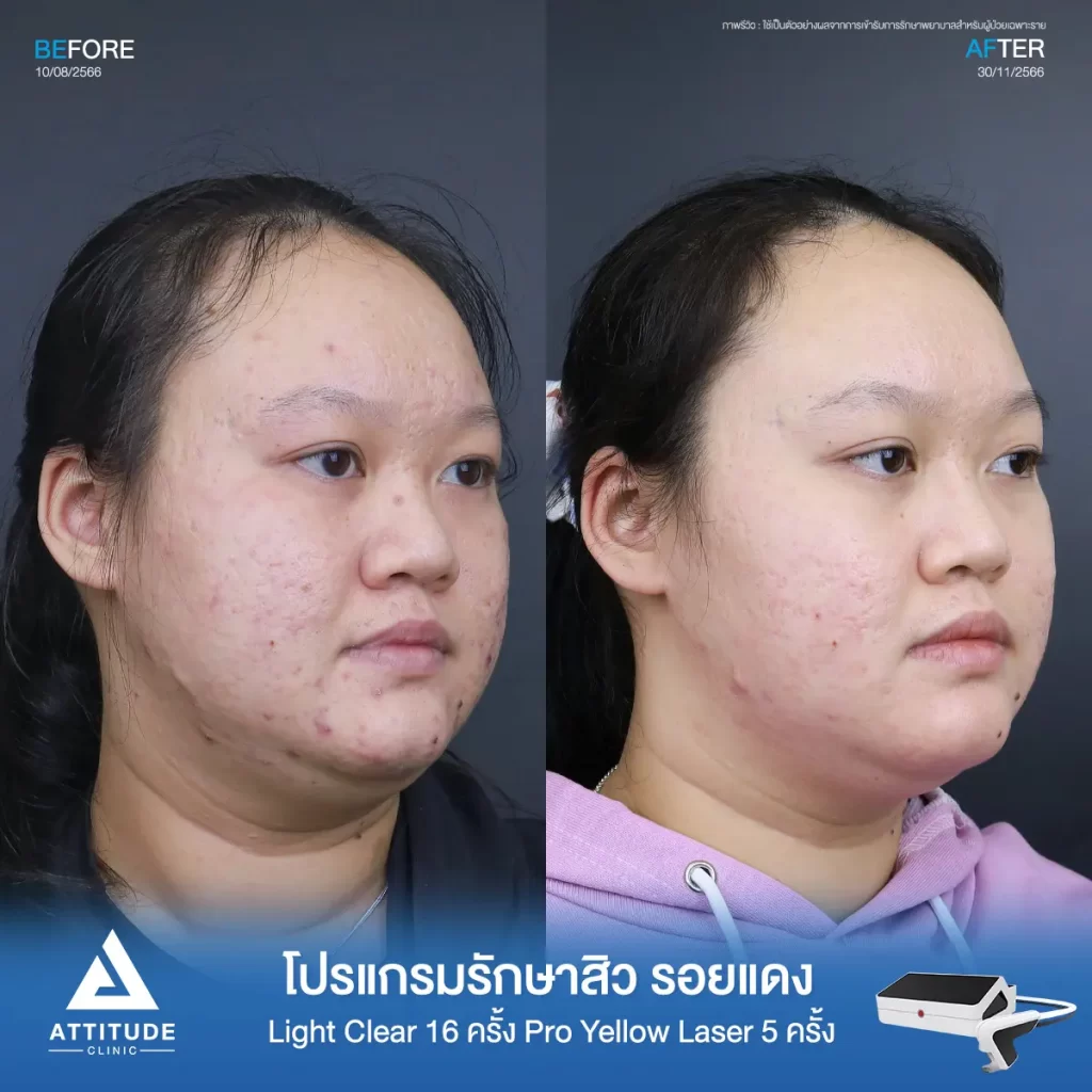 รีวิวรักษาสิวคุณกฤตชญา ด้วยการฉายแสงโปรแกรมรักษาสิว Light Clear 7 ขั้นตอน จำนวน 16 ครั้ง ต่อด้วย Pro Yellow Laser รักษารอยแดง จำนวน 5 ครั้ง รักษาสิวอักเสบ สิวอุดตัน รอยแดงจากสิวทั่วใบหน้าโดยเฉพาะบริเวณแก้มที่ Attitude Clinic