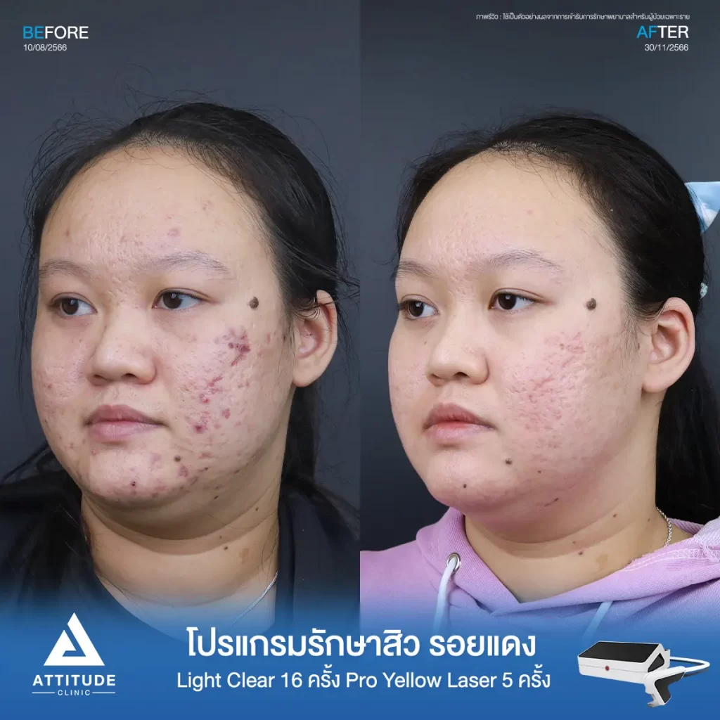 รีวิวรักษาสิวคุณกฤตชญา ด้วยการฉายแสงโปรแกรมรักษาสิว Light Clear 7 ขั้นตอน จำนวน 16 ครั้ง ต่อด้วย Pro Yellow Laser รักษารอยแดง จำนวน 5 ครั้ง รักษาสิวอักเสบ สิวอุดตัน รอยแดงจากสิวทั่วใบหน้าโดยเฉพาะบริเวณแก้มที่ Attitude Clinic