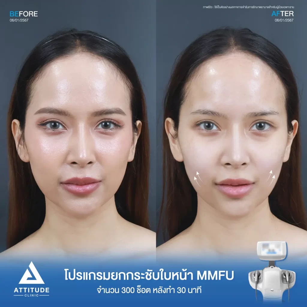 รีวิวโปรแกรม Ultraformer III จำนวน 300 ช็อต หลังทำ 30 นาทีของคุณนกยูง ยกกระชับผิว ปรับรูปหน้า ลดกระเปาะแก้ม สลายไขใต้คาง เหนียงที่ Attitude Clinic