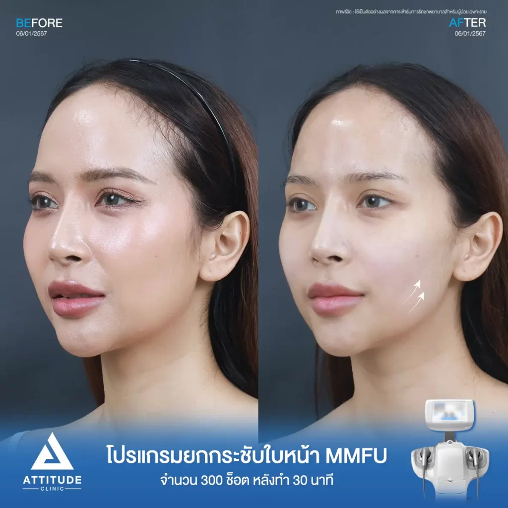 รีวิวโปรแกรมยกกระชับใบหน้า MMFU จำนวน 300 ช็อต หลังทำ 30 นาทีของคุณนกยูง ยกกระชับผิว ปรับรูปหน้า ลดกระเปาะแก้ม สลายไขใต้คาง เหนียงที่ Attitude Clinic