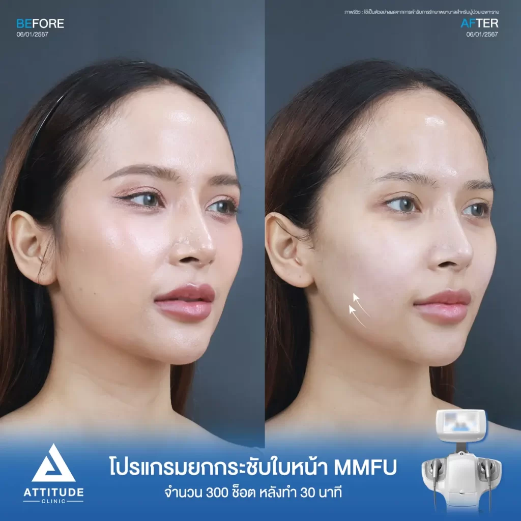 รีวิวโปรแกรมยกกระชับใบหน้า MMFU จำนวน 300 ช็อต หลังทำ 30 นาทีของคุณนกยูง ยกกระชับผิว ปรับรูปหน้า ลดกระเปาะแก้ม สลายไขใต้คาง เหนียงที่ Attitude Clinic