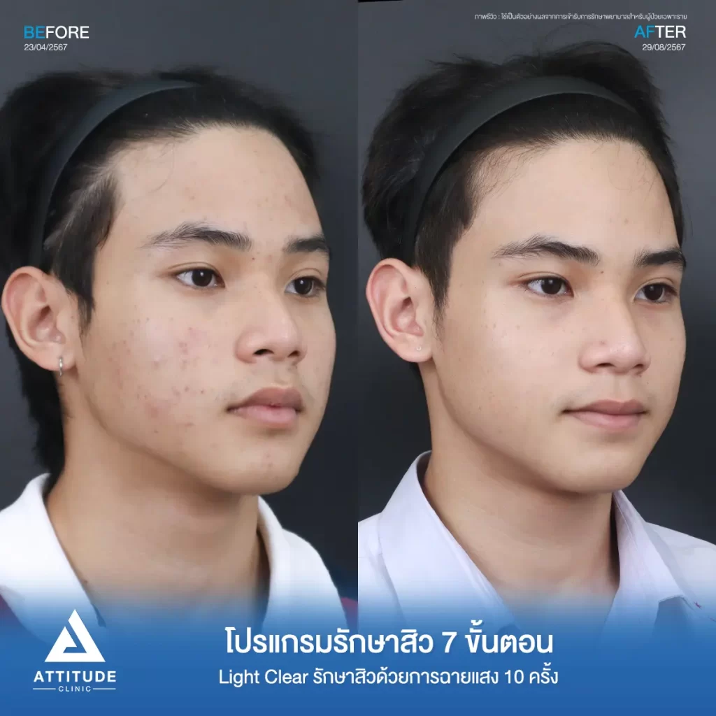 รีวิวรักษาสิวน้องแต๊งส์ ด้วยการฉายแสง โปรแกรมรักษาสิว Light Clear 7 ขั้นตอน จำนวน 10 ครั้ง รักษาสิวฮอร์โมน สิวอักเสบ สิวอุดตันเม็ดเล็กๆ รอยแดงทั่วใบหน้าที่ Attitude Clinic