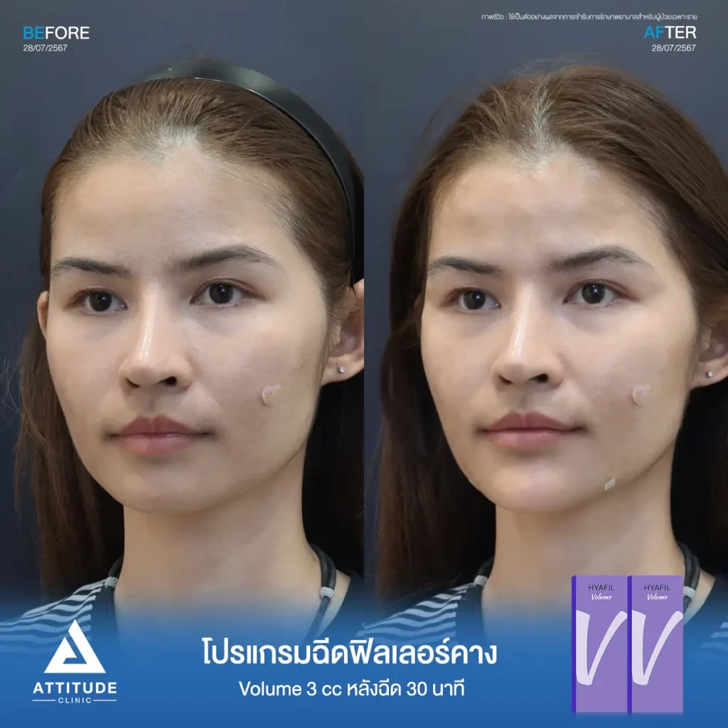 รีวิวโปรแกรมฉีดฟิลเลอร์คางคุณนัยเนตร จำนวน 3 cc รุ่น V จำนวน 3 cc หลังฉีด 30 นาที เติมเต็มคาง ปรับรูปหน้าให้เรียวสวยได้รูป เพิ่มมิติให้ใบหน้าได้สัดส่วนที่ Attitude Clinic