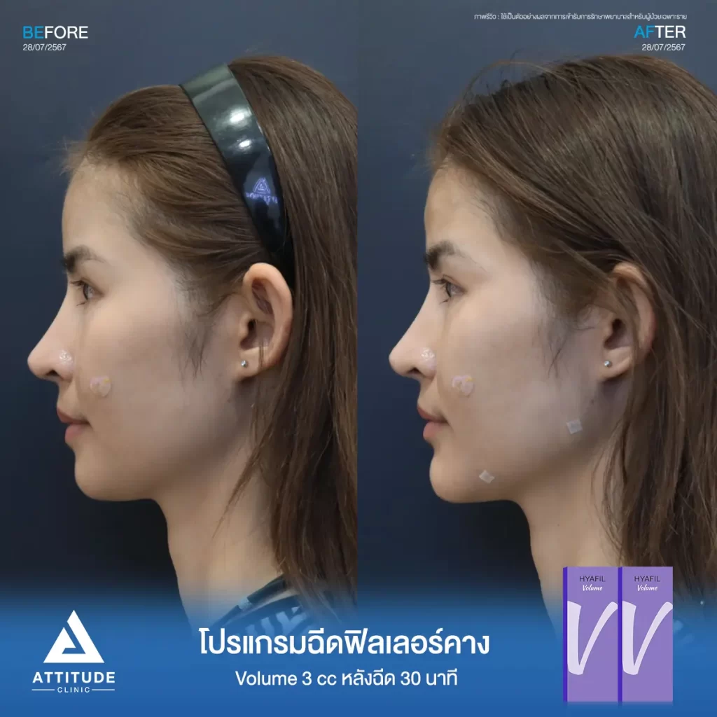 รีวิวโปรแกรมฉีดฟิลเลอร์คางคุณนัยเนตร จำนวน 3 cc รุ่น V จำนวน 3 cc หลังฉีด 30 นาที เติมเต็มคาง ปรับรูปหน้าให้เรียวสวยได้รูป เพิ่มมิติให้ใบหน้าได้สัดส่วนที่ Attitude Clinic