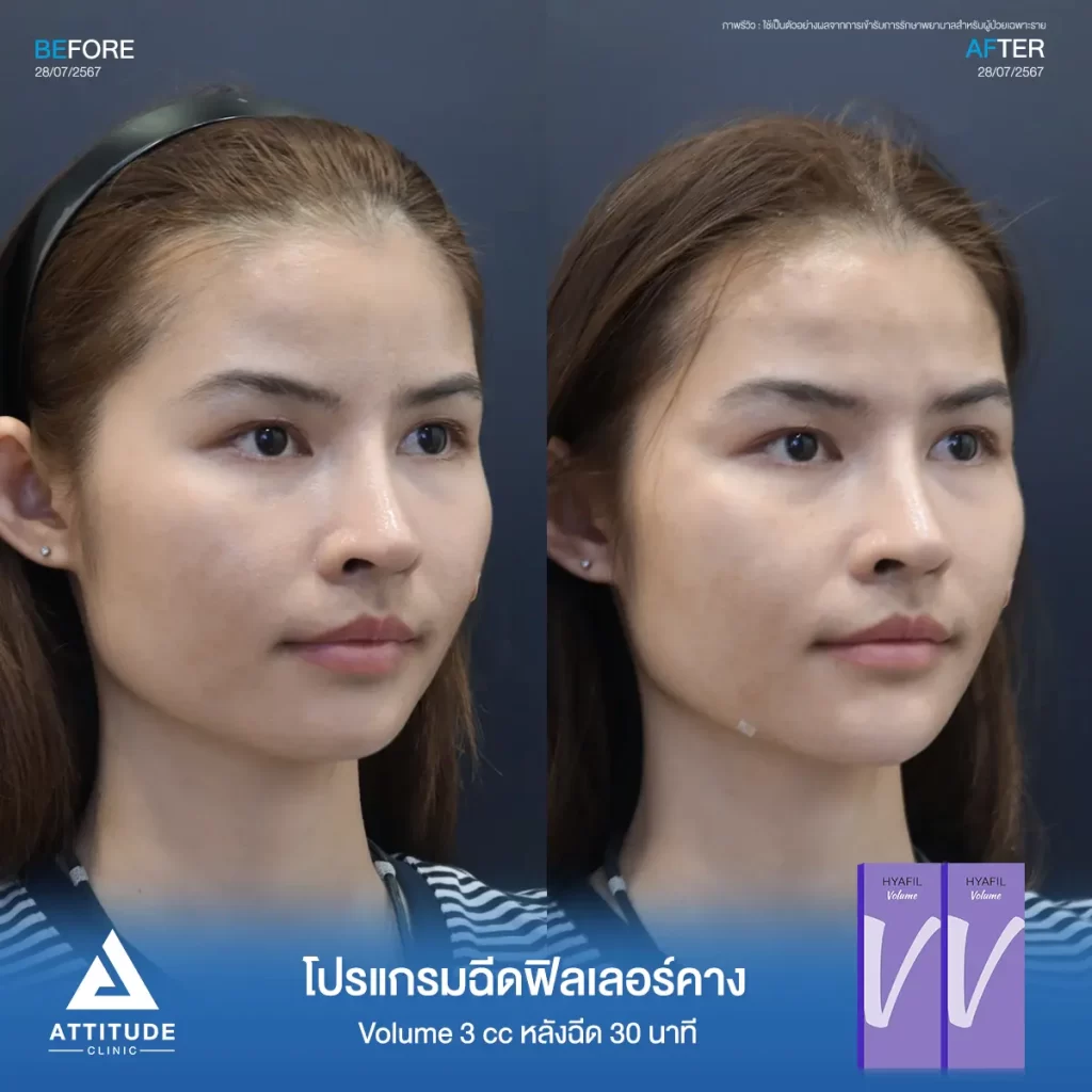 รีวิวโปรแกรมฉีดฟิลเลอร์คางคุณนัยเนตร จำนวน 3 cc รุ่น V จำนวน 3 cc หลังฉีด 30 นาที เติมเต็มคาง ปรับรูปหน้าให้เรียวสวยได้รูป เพิ่มมิติให้ใบหน้าได้สัดส่วนที่ Attitude Clinic