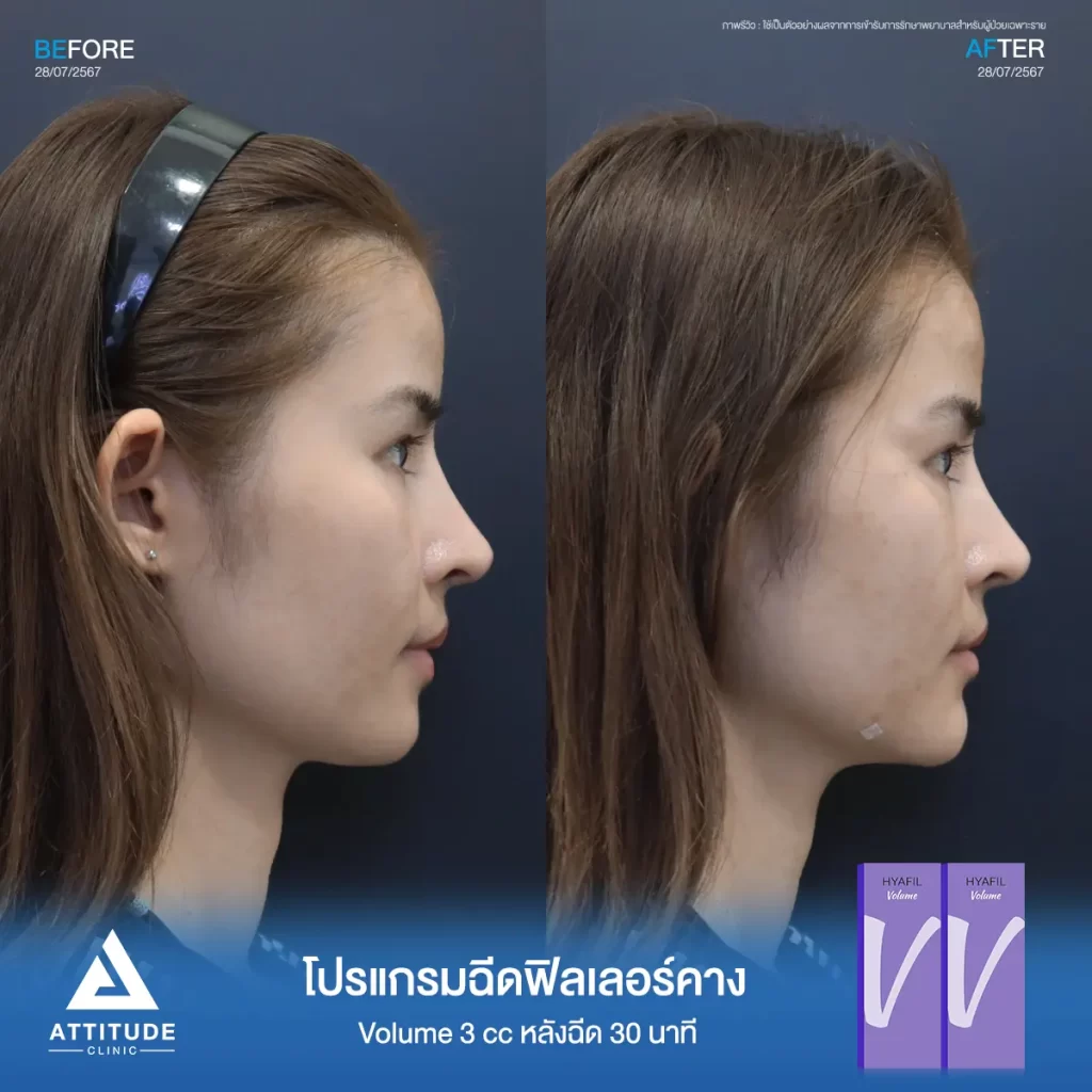 รีวิวโปรแกรมฉีดฟิลเลอร์คางคุณนัยเนตร จำนวน 3 cc รุ่น V จำนวน 3 cc หลังฉีด 30 นาที เติมเต็มคาง ปรับรูปหน้าให้เรียวสวยได้รูป เพิ่มมิติให้ใบหน้าได้สัดส่วนที่ Attitude Clinic