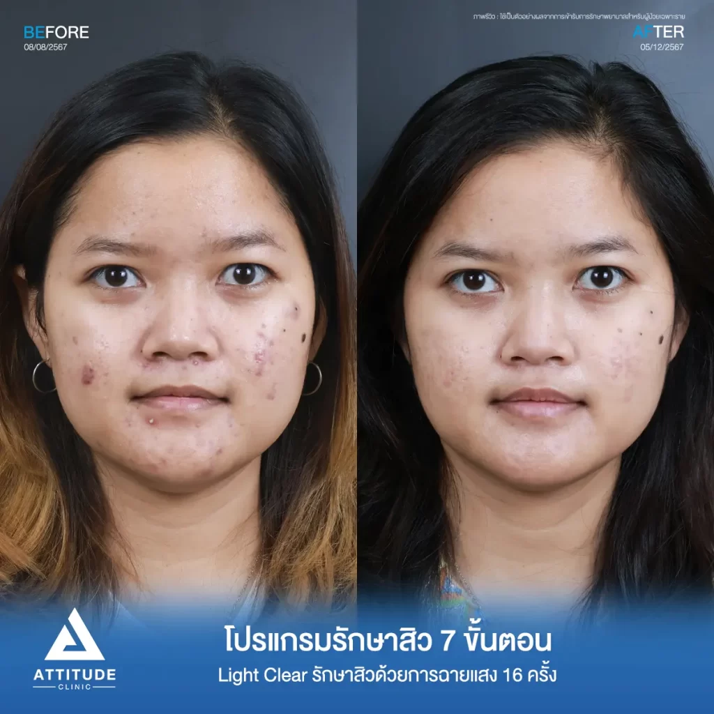 รีวิวรักษาสิวคุณลูกน้ำ ด้วยการฉายแสง โปรแกรมรักษาสิว Light Clear 7 ขั้นตอน จำนวน 16 ครั้ง รักษาสิวอักเสบเม็ดใหญ่ สิวหนอง สิวฮอร์โมน รอยแดงทั่วใบหน้าที่ Attitude Clinic