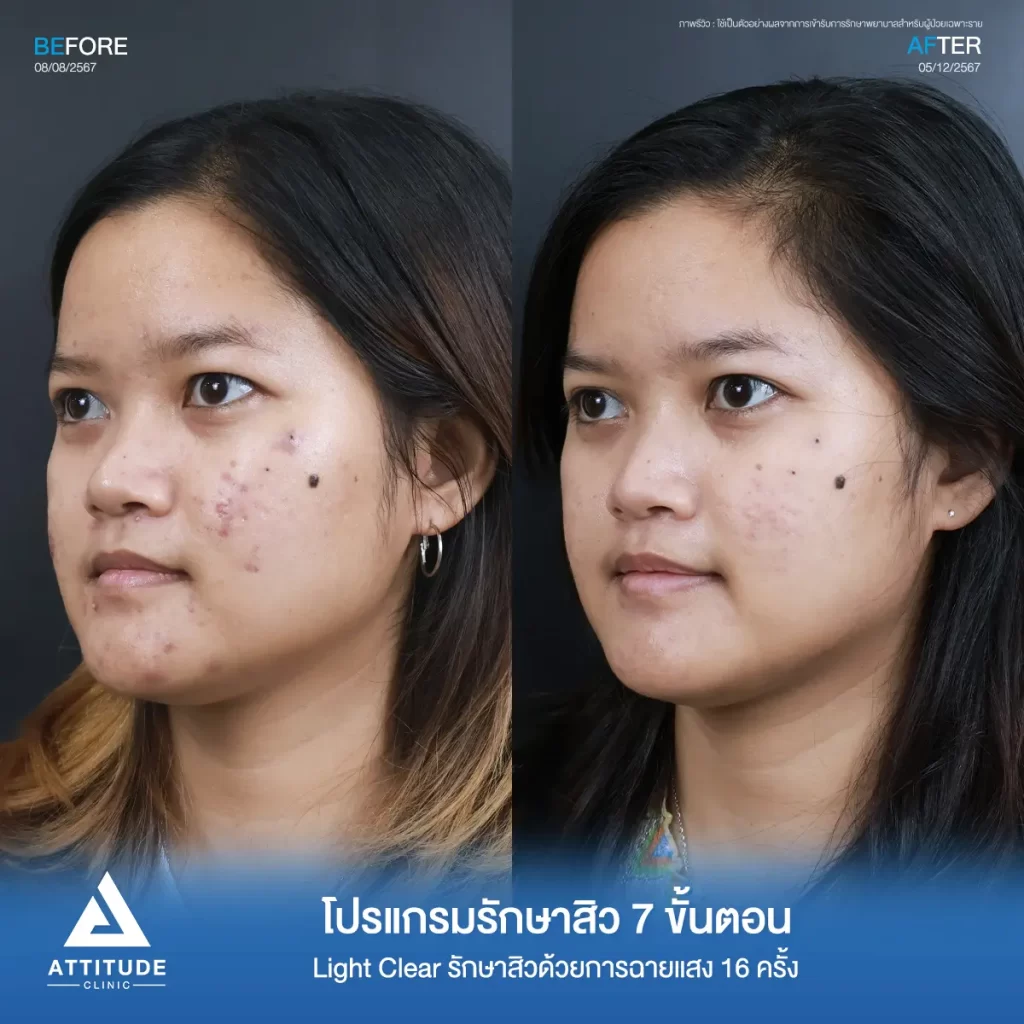 รีวิวรักษาสิวคุณลูกน้ำ ด้วยการฉายแสง โปรแกรมรักษาสิว Light Clear 7 ขั้นตอน จำนวน 16 ครั้ง รักษาสิวอักเสบเม็ดใหญ่ สิวหนอง สิวฮอร์โมน รอยแดงทั่วใบหน้าที่ Attitude Clinic