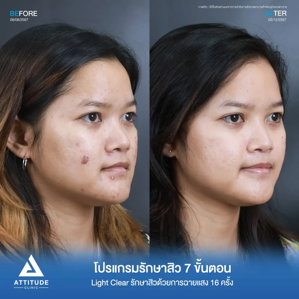 รีวิวรักษาสิวคุณลูกน้ำ ด้วยการฉายแสง โปรแกรมรักษาสิว Light Clear 7 ขั้นตอน จำนวน 16 ครั้ง รักษาสิวอักเสบเม็ดใหญ่ สิวหนอง สิวฮอร์โมน รอยแดงทั่วใบหน้าที่ Attitude Clinic