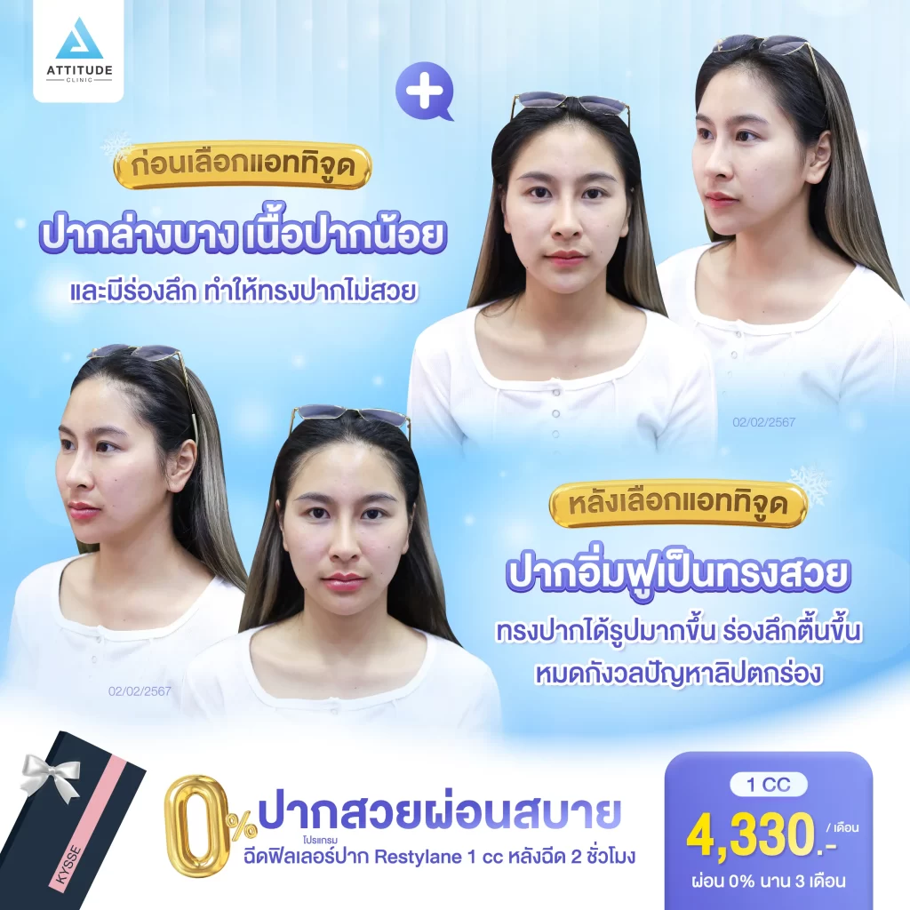 รวมรีวิวโปรแกรมฉีดฟิลเลอร์ จ่ายน้อยแต่หน้าแพงมากกกกก ทำสวยผ่อนได้ 0% นานสูงสุด 6 เดือน