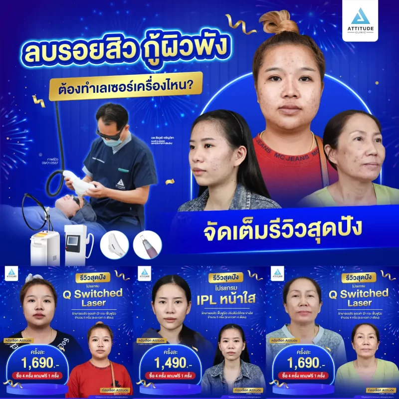 รวมรีวิวรักษารอยสิวสุดปัง อยากลบรอยสิว กู้ผิวพัง เลือกทำเลเซอร์เครื่องไหนดี !?