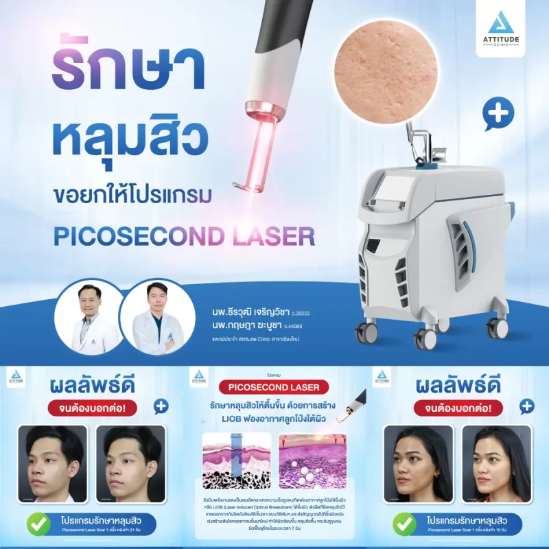 รักษาหลุมสิว ขอยกให้โปรแกรม Picosecond Laser รักษาครอบคลุมปัญหาผิว กระตุ้นสร้างคอลลาเจนใหม่ ให้ผิวเรียบเนียน หลุมสิวตื้นขึ้นด้วยการสร้าง LIOB ฟองอากาศลูกโป่งใต้ผิว